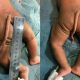 Bebê nasce com cauda de 13 centímetros na Colômbia