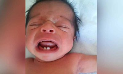 Em caso raro, bebê nasce com dois dentes e surpreende pais e médicos