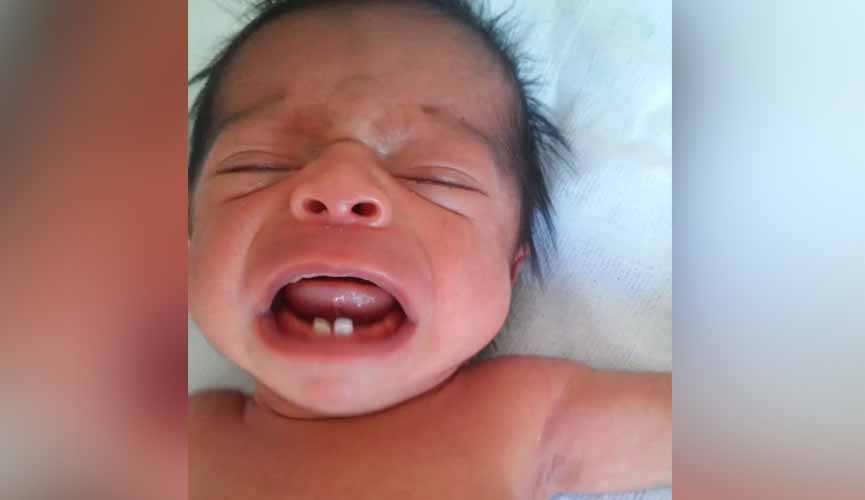 Em caso raro, bebê nasce com dois dentes e surpreende pais e médicos