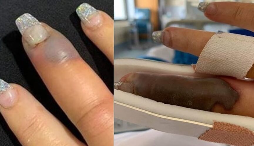 Mulher quase perde o dedo após contrair infecção em manicure