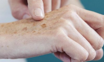 Oncologista de Jundiaí explica sintomas, tratamentos e prevenção do câncer de pele
