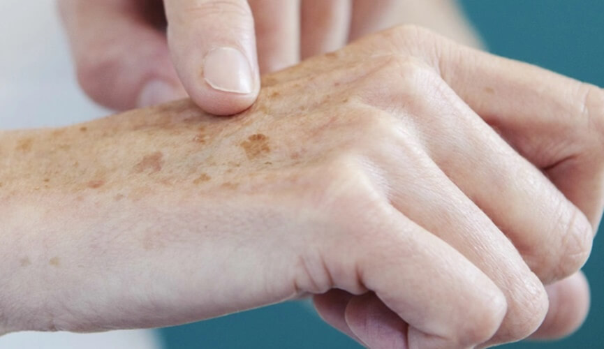 Oncologista de Jundiaí explica sintomas, tratamentos e prevenção do câncer de pele