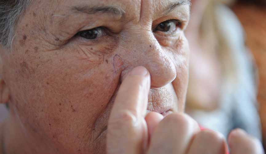 Rosto de idosa em que ela aponta para pinta em seu rosto que está circulada de caneta: a mancha é um câncer de pele