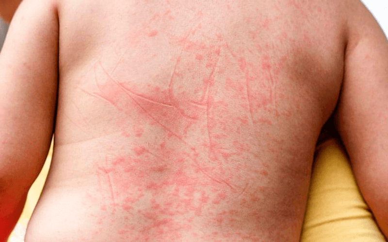 Criança de costas com pintinhas vermelhas no corpo