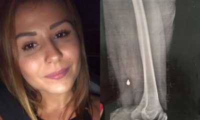 mulher sorrindo e ao lado sua radiografia mostrando uma bala alojada na perna