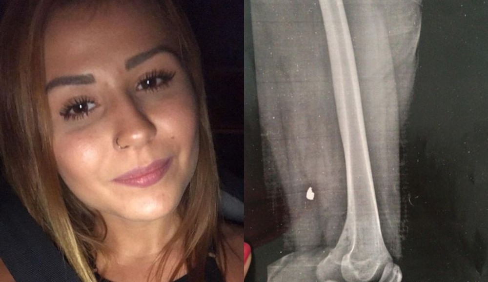 mulher sorrindo e ao lado sua radiografia mostrando uma bala alojada na perna