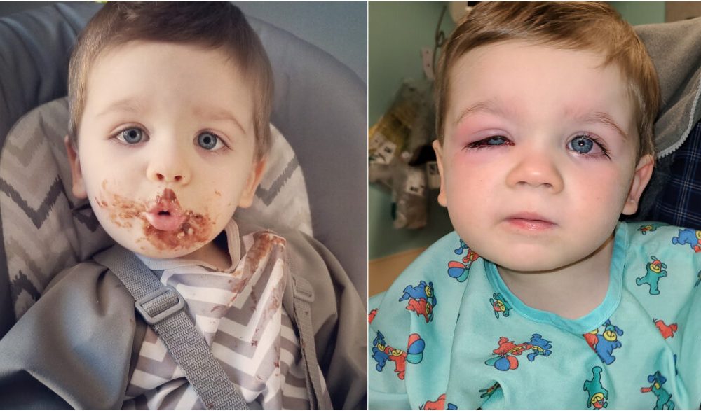 Comparação com fotos da criança antes e depois da bactéria nos olhos.