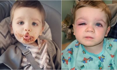 Comparação com fotos da criança antes e depois da bactéria nos olhos.