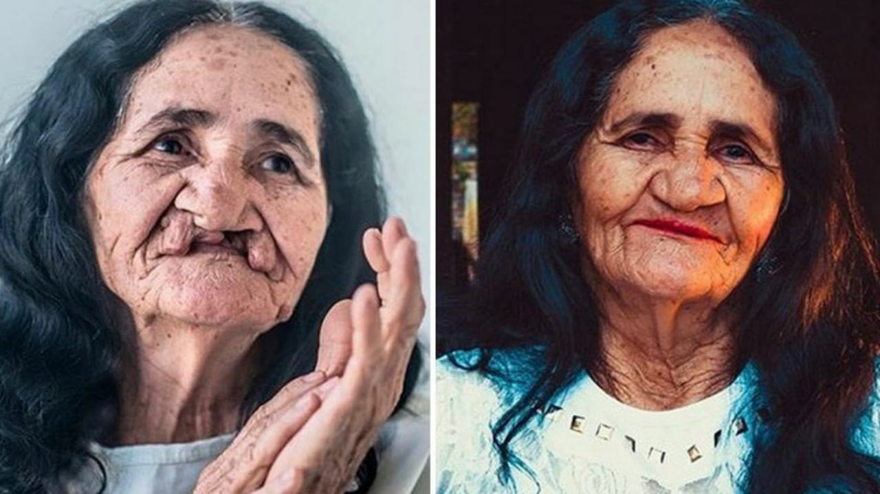 Antes e depois da cirurgia para correção do lábio leporino de Dona Maria, de 67 anos.