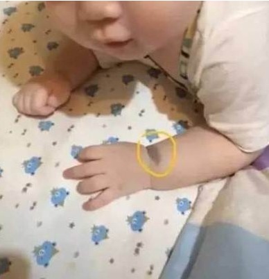 Bebê com marca de nascença no braço