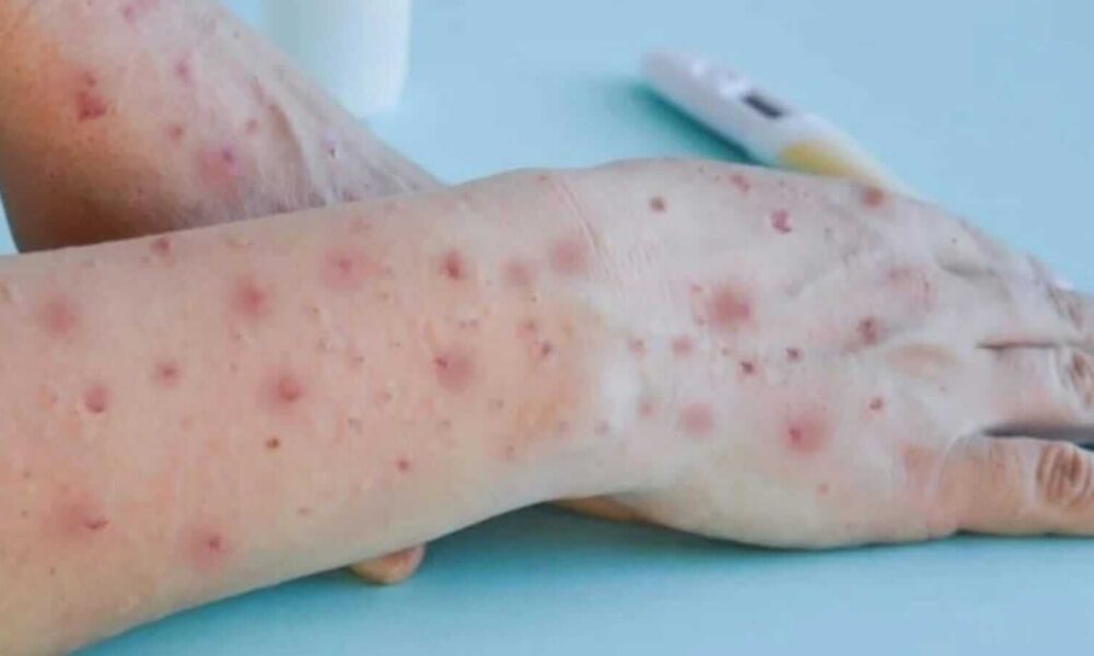 Varíola dos Macacos - monkeypox
