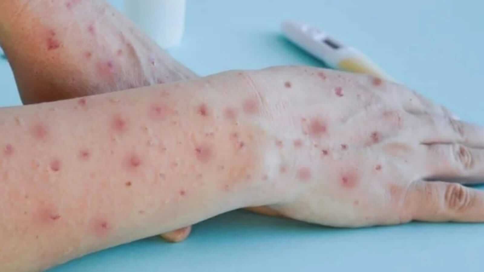 Varíola dos Macacos - monkeypox