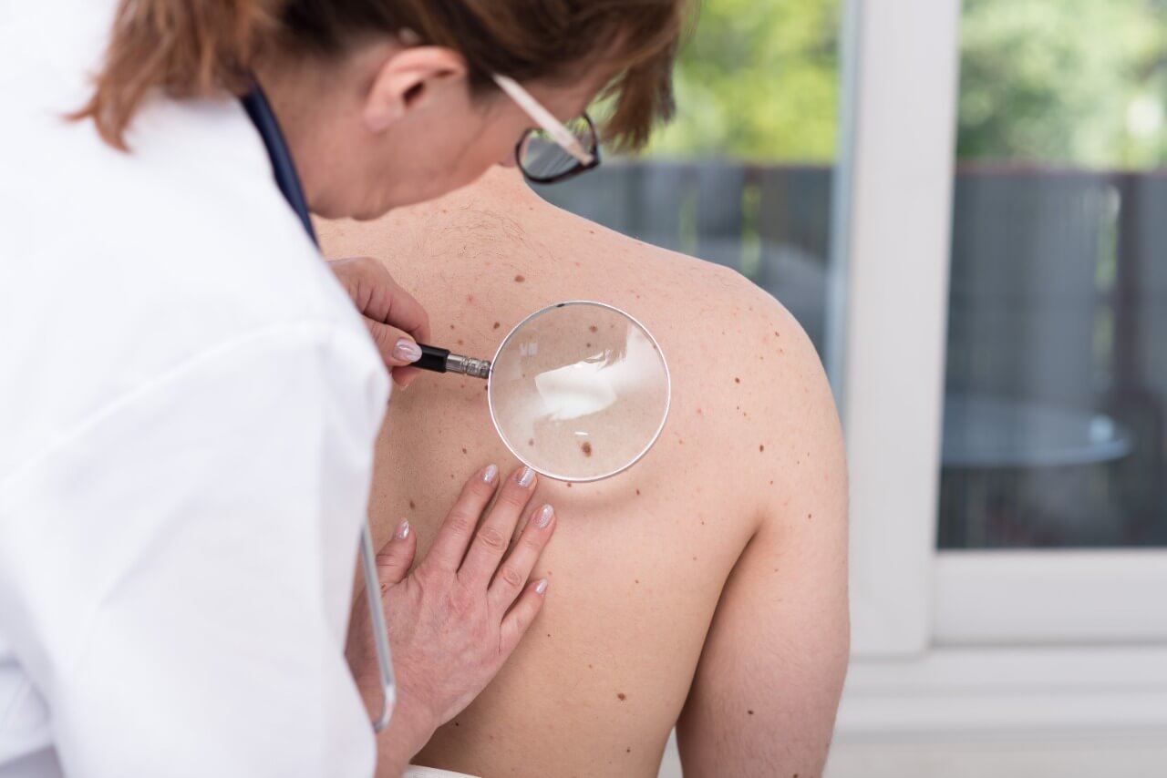 Ação para detecção de câncer de pele é realizada há 20 anos